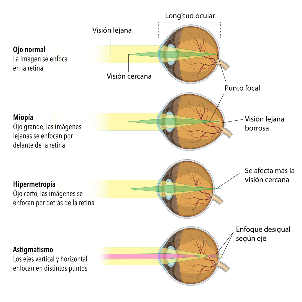 Astigmatismo con miopía a la vez