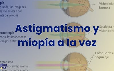 Astigmatismo y miopía al mismo tiempo